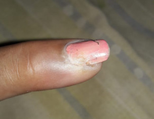 Swelling On Finger &amp; Nail