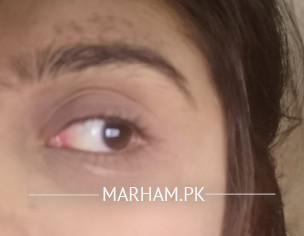 White Patch Under Eye