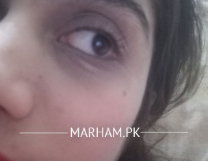 White Patch Under Eye