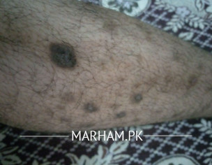 Skin Problem