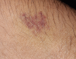 Red/Brown Marks On Arm
