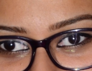 Eye Squint After Dlvry