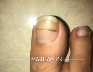 Toenail Discolouration 