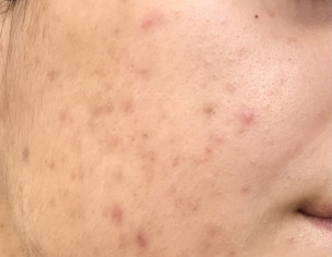Acne And Blemishes