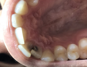 Tooth Cavity 