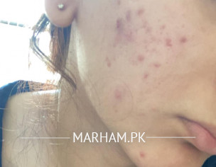Severe Acne, High Testosterone 