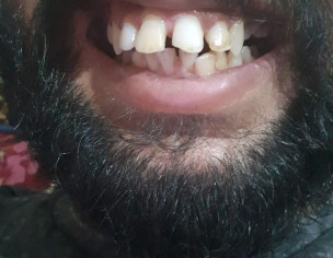 Can I Get My Teeth Sorted With Braces?
