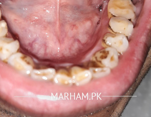 Oral Thrush Or Something Else?