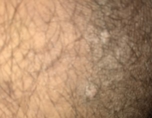 Ring Worms On Thighs