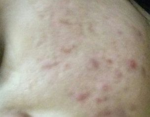 Acne Issue