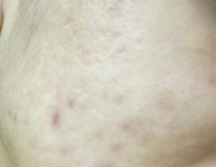 Acne Issue