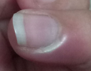 Pus Around Nail