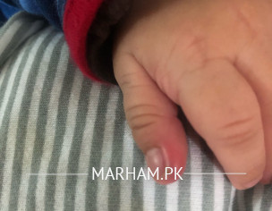 1 Month Old Finger Redness