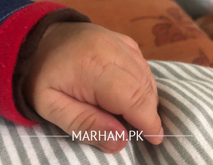 1 Month Old Finger Redness