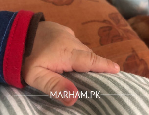 1 Month Old Finger Redness