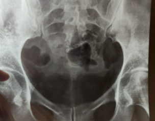 Orthopaedic: Tailbone Issue