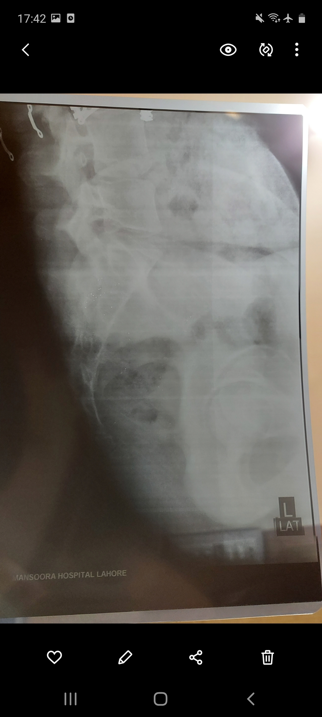 Can an Orthopedic Surgeon Help Me with Tailbone Pain in My Spine