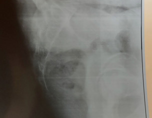 Orthopaedic: Tailbone Issue