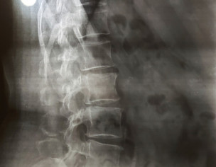 Orthopaedic: Tailbone Issue