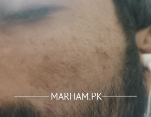 Skin Problem For Long Time