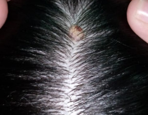 Boil/Acne On Scalp