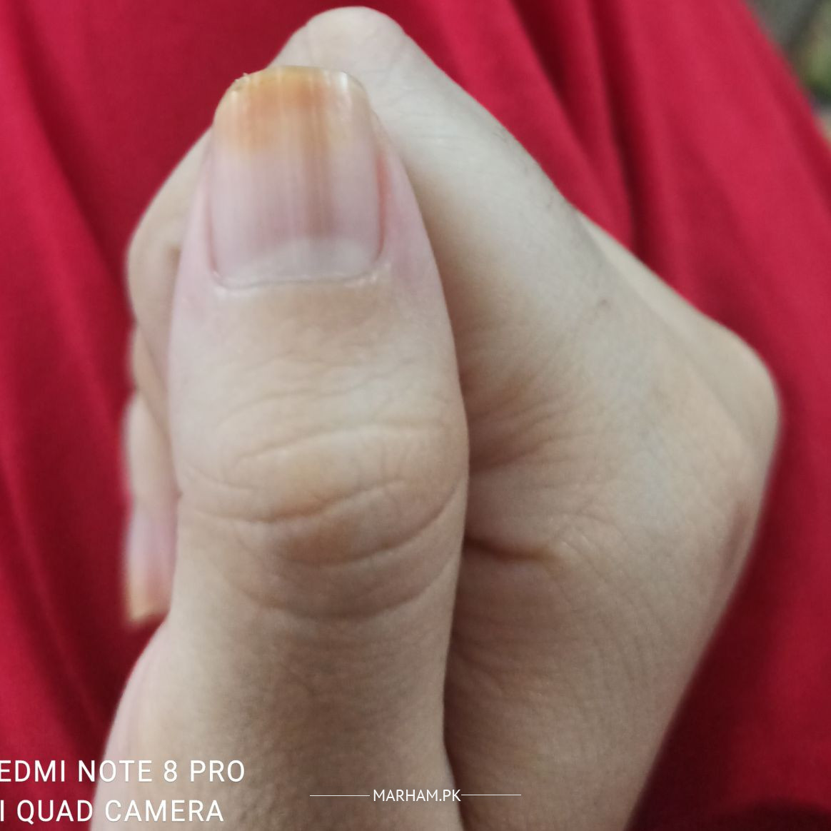 Fixing my nail psoriasis : r/Psoriasis