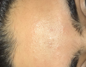 Allergy On Face, Neck N Forhead