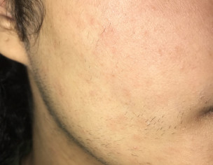 Allergy On Face, Neck N Forhead