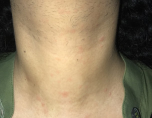 Allergy On Face, Neck N Forhead