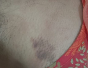 Irritating Skin Rash