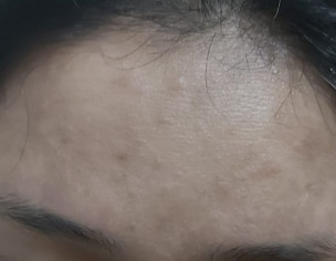 Irritating Skin Rash