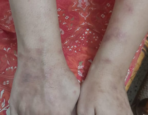 Irritating Skin Rash