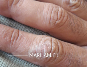 Skin Problem On Hands & Feet Also On Face...