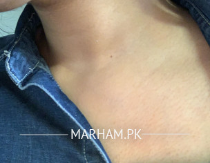 Facial And Back Acne