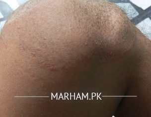 Ringworm Or Jock Itch