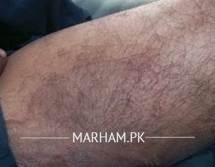 Ringworm Or Jock Itch