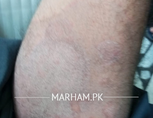 Ringworm Or Jock Itch