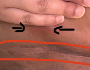 Csec Scar (gynaecologist).