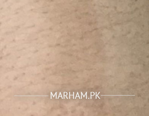 Stomach Burning Scar 