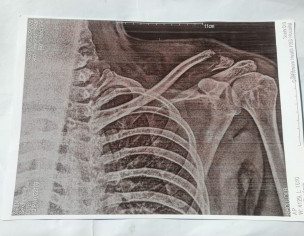 Clavical Bone Fracture