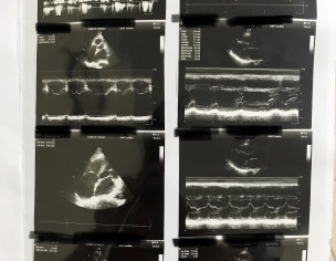 Heart Echocardiography 