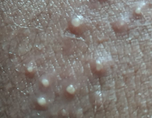 Weird blister/welt on inner thigh (tmi- pic) - Page 2