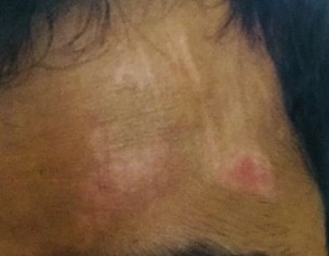 Scars On My Forehead 