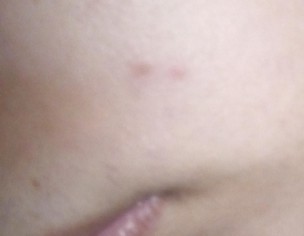 Skin Issue