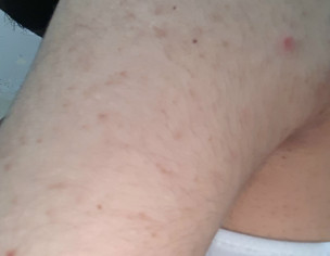 Acne Marks On Shoulders 