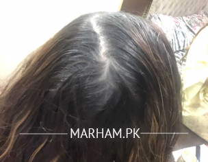 Hair Loss-thinning