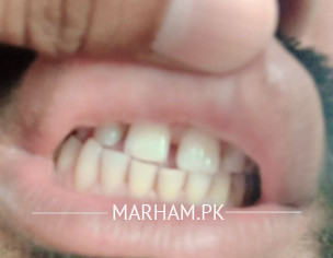 Gap In Teeth