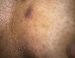 Lymph On Chest