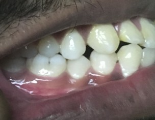 Malocclusion Class 2