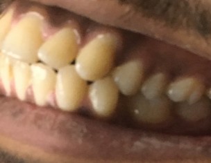 Malocclusion Class 2